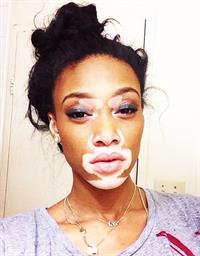 Winnie Harlow